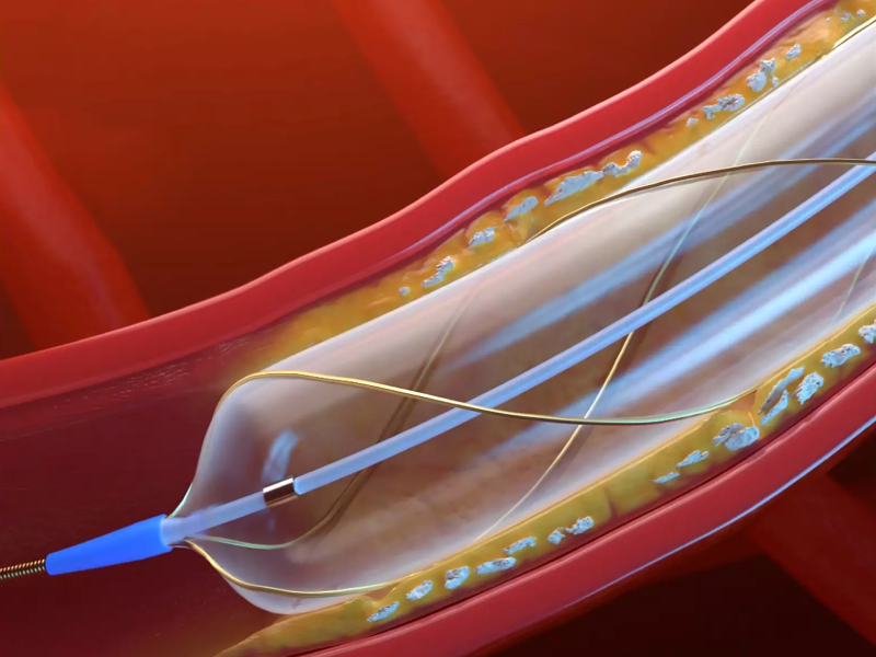 Balloon Catheters Balloon Catheters